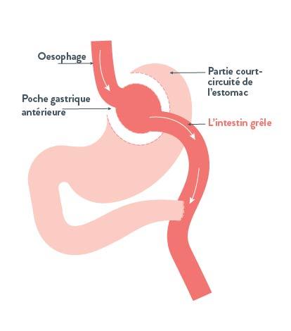 La Dérivation Gastrique (gastric Bypass) | Barinutrics